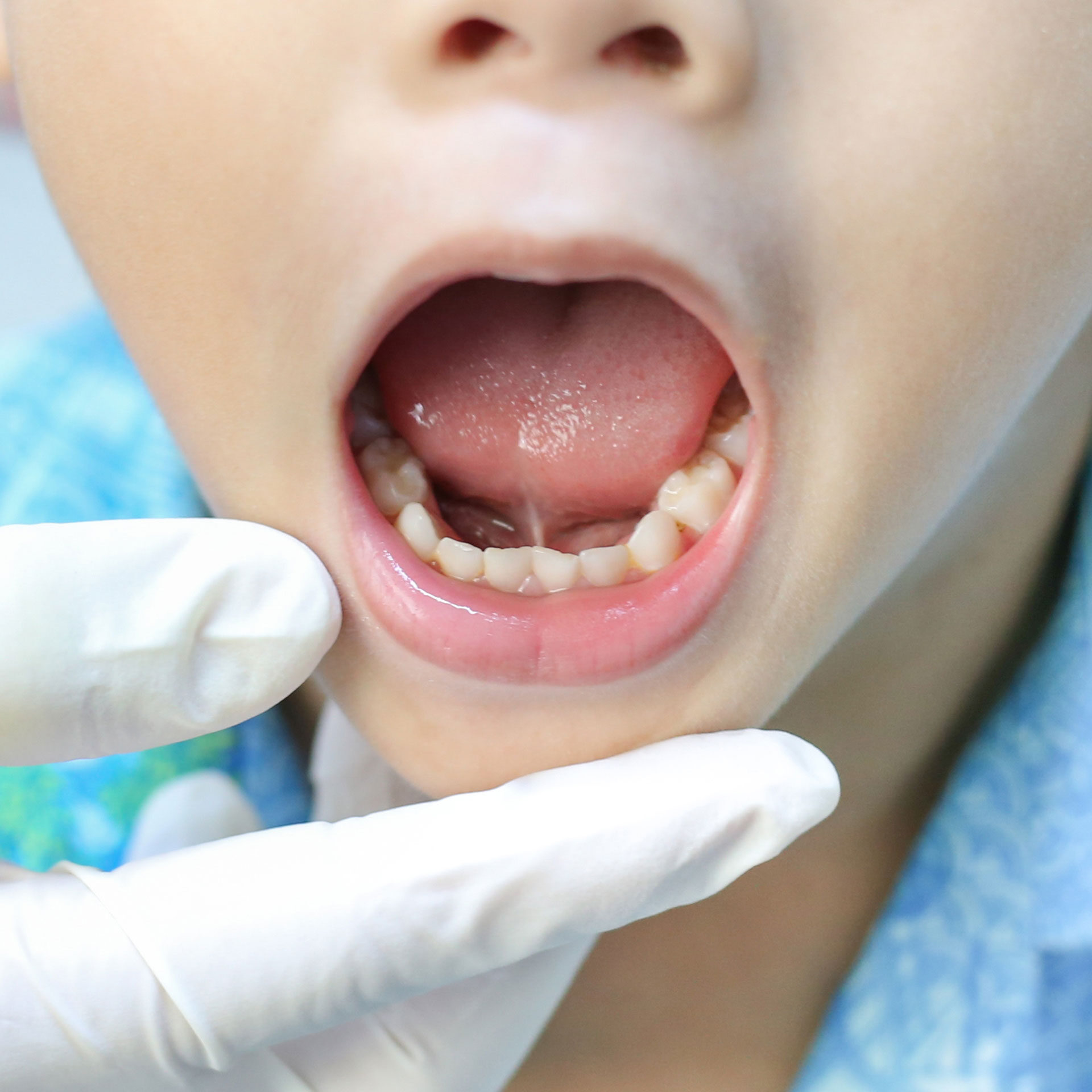 child with tongue tie